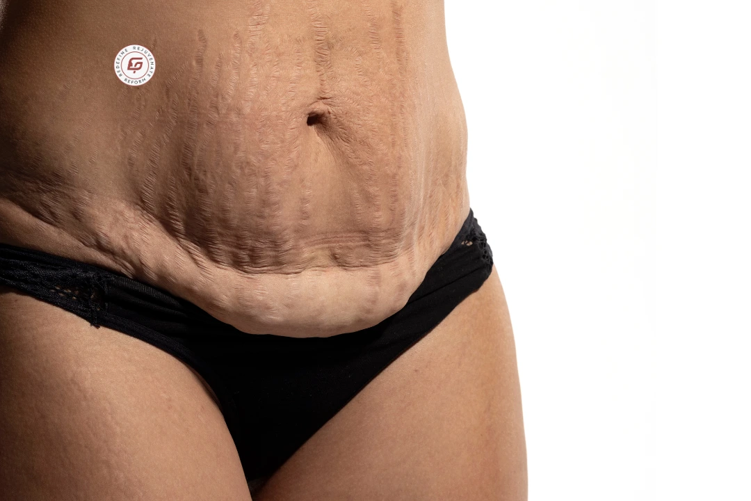 liposuction after c section, post c section fat removal, c section belly fat treatment, tummy liposuction after delivery, liposuction in indore, dr geetika paliwal, cosmetic surgeon indore, mommy makeover indore, post pregnancy body contouring, lower belly fat after c section, c section pouch fat removal, abdominal liposuction, safe liposuction after c section, post delivery fat removal treatment, c section scar fat removal, body contouring for moms, fat reduction after childbirth, cosmetic surgery indore, liposuction specialist indore, post pregnancy tummy treatment, fat removal surgery indore, c section recovery and liposuction, tummy reshaping after c section, stubborn belly fat post c section, fat deposit removal for moms