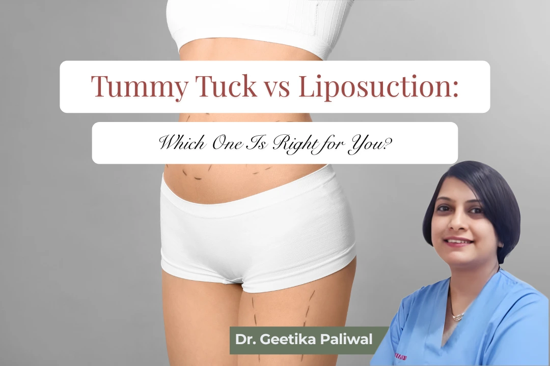 tummy tuck in Indore, liposuction in Indore, tummy tuck surgery Indore, liposuction surgery Indore, abdominoplasty in Indore, body contouring in Indore, cosmetic surgeon in Indore, plastic surgeon in Indore, Dr. Geetika Paliwal Indore, tummy fat removal Indore, loose skin removal Indore, abdominal contouring Indore, post-pregnancy tummy tuck Indore, mommy makeover Indore, stubborn belly fat treatment Indore, abdominal liposuction Indore, tummy tightening surgery Indore, skin tightening surgery Indore, body shaping surgery Indore, tummy tuck consultation Indore, liposuction consultation Indore, best tummy tuck surgeon in Indore, best liposuction surgeon in Indore, female cosmetic surgeon Indore, cosmetic surgery clinic Indore, tummy tuck cost in Indore, liposuction cost in Indore, mini tummy tuck Indore, full tummy tuck Indore, tummy tuck and liposuction Indore