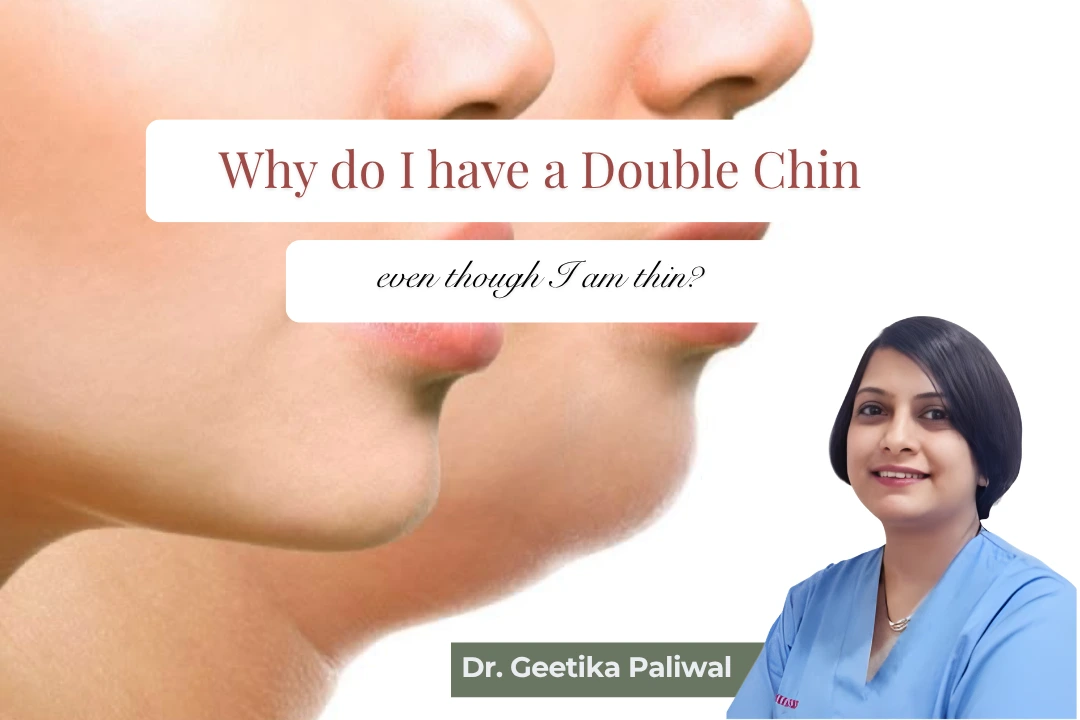 double chin despite being thin; plastic surgeon in Indore, why do thin people have a double chin; causes of a double chin; double chin genetics; loose skin under the chin; chin and neck fat; double chin with normal weight; skin laxity under the chin; when to consider double chin treatment; double chin consultation in Indore, best cosmetic surgeon in Indore, double chin treatment in Indore, double chin even though thin, causes of double chin, double chin in slim people, why do thin people have double chin, double chin removal Indore, double chin reduction Indore, chin fat treatment Indore, submental fat treatment Indore, plastic surgeon in Indore, best plastic surgeon in Indore, Dr Geetika Paliwal, cosmetic surgeon in Indore, chin liposuction Indore, double chin liposuction Indore