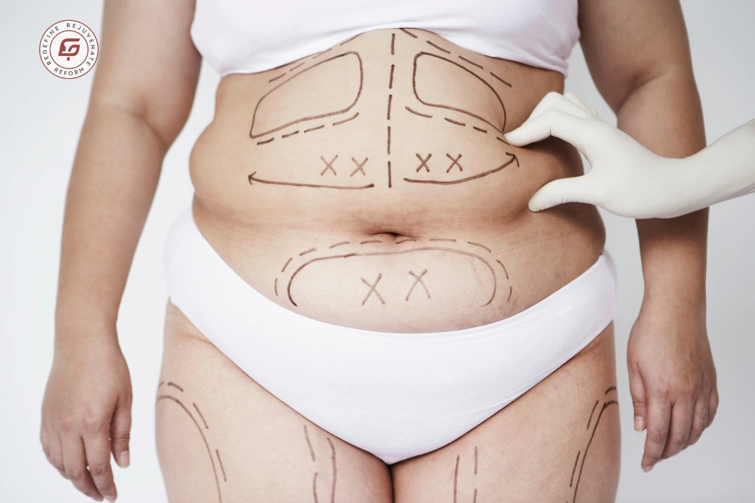 best cosmetologist in indore, liposuction in indore, body contouring indore, fat removal surgery indore, cosmetic surgery indore, liposuction cost indore, abdomen liposuction indore, thigh liposuction indore, arm liposuction indore, chin liposuction indore, safe liposuction indore, advanced liposuction indore, cosmetic clinic indore, body shaping indore, fat reduction treatment indore, cosmetic procedures indore, liposuction recovery, aesthetic treatments indore, cosmetic expert indore, plastic surgery indore, body sculpting indore, liposuction specialist indore, cosmetic doctor indore, non obesity fat removal, natural liposuction results