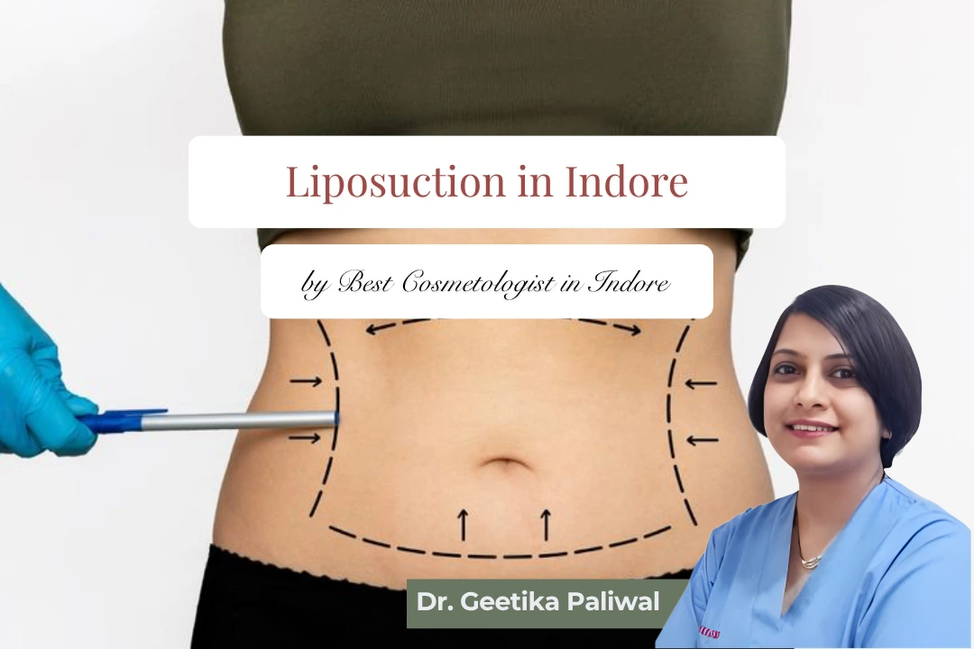 liposuction clinic in Indore, best liposuction Indore, cosmetic surgeon Indore, fat reduction Indore, tummy liposuction Indore, thigh liposuction Indore, arm liposuction Indore, liposuction surgery Indore, laser liposuction Indore, VASER liposuction Indore, advanced liposuction Indore, liposuction cost Indore, liposuction expert Indore, liposuction doctor Indore, body shaping Indore, non-invasive fat removal Indore, liposuction recovery Indore, contouring procedures Indore, aesthetic clinic Indore, cosmetic treatments Indore, best surgeon Indore, liposuction results Indore, plastic surgery Indore, body sculpting Indore, liposuction safety Indore, personalized liposuction Indore, Indore cosmetic procedures, liposuction packages Indore, experienced cosmetologist Indore, liposuction consultation Indore