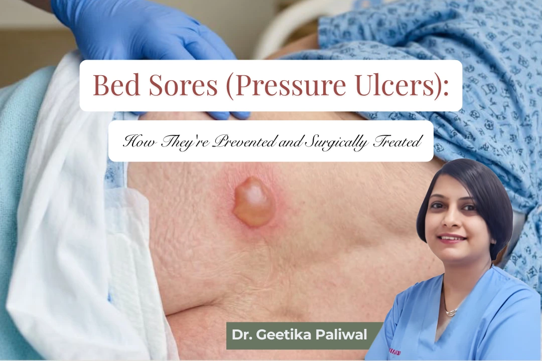 Bed Sores (Pressure Ulcers), pressure ulcer treatment, bed sore prevention, pressure sore surgery, flap reconstruction for pressure ulcers, bed sores treatment in Indore, pressure ulcer treatment in Indore, bed sore doctor in Indore, pressure sore specialist Indore, bed sore surgery in Indore, pressure ulcer surgery in Indore, pressure wound treatment Indore, bed sore wound care Indore, pressure injury treatment Indore, decubitus ulcer treatment Indore, chronic wound treatment Indore, wound care specialist Indore, plastic surgeon for bed sores Indore, reconstructive surgeon for pressure ulcers Indore, flap surgery for bed sores Indore, pressure ulcer flap surgery Indore, debridement for bed sores Indore, bed sore debridement Indore, sacral pressure ulcer treatment Indore, heel pressure ulcer treatment Indore, stage 3 pressure ulcer treatment Indore, stage 4 pressure ulcer surgery Indore, bed sore treatment near me Indore, pressure ulcer doctor near me Indore, bed sore specialist near me Indore, wound reconstruction surgery Indore, pressure ulcer care in Indore, advanced bed sore treatment Indore, non healing wound treatment Indore, pressure sore plastic surgery Indore