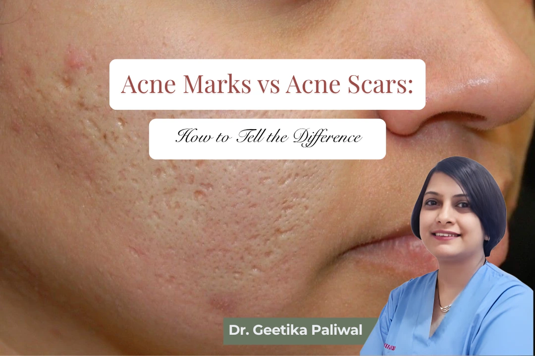 acne marks vs acne scars, difference between acne marks and acne scars, acne marks treatment, acne scars treatment, acne marks treatment in Indore, acne scars treatment in Indore, acne scar removal treatment Indore, acne pigmentation treatment Indore, acne scar treatment by Dr. Geetika Paliwal, acne marks treatment by Dr. Geetika Paliwal, acne scar doctor in Indore, acne specialist in Indore, dermatologist for acne scars in Indore, facial acne scars treatment Indore, pitted acne scars treatment, ice pick scars treatment, boxcar scars treatment, rolling acne scars treatment, post acne marks treatment, post inflammatory hyperpigmentation treatment, dark spots after acne treatment, acne pigmentation removal, acne scar reduction, acne scar procedures, microneedling for acne scars Indore, chemical peel for acne marks Indore, laser treatment for acne scars Indore, acne scar specialist Dr. Geetika Paliwal, best acne scar treatment in Indore, acne marks and scars treatment Indore
