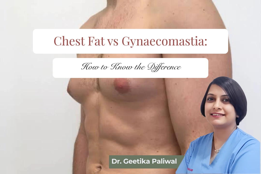 Chest fat vs gynaecomastia, chest fat in men, gynaecomastia in men, male chest enlargement, pseudogynaecomastia, gynaecomastia treatment in Indore, gynaecomastia surgery in Indore, male breast reduction in Indore, chest fat removal in Indore, gynaecomastia surgeon in Indore, plastic surgeon in Indore, cosmetic surgeon in Indore, Dr. Geetika Paliwal.