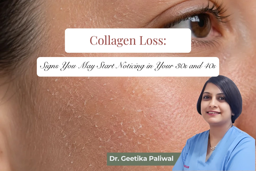 collagen loss, collagen loss symptoms, signs of collagen loss, collagen loss in 30s, collagen loss in 40s, skin ageing in 30s, skin ageing in 40s, collagen production, ageing skin, fine lines and wrinkles, sagging skin, loss of skin elasticity, skin firmness, facial ageing, facial collagen loss, collagen breakdown, premature skin ageing, sun damage and collagen, anti ageing skincare, collagen stimulation treatment, microneedling for collagen, MNRF treatment, PRP for skin, skin rejuvenation, skin tightening treatment, ageing skin treatment, wrinkle treatment, facial rejuvenation, skin elasticity treatment, collagen boosting treatment