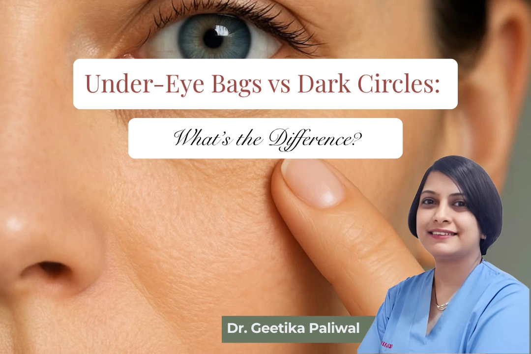 under eye bags, dark circles, under eye bags treatment, dark circles treatment, under eye bags vs dark circles, under eye treatment in Indore, dark circles treatment in Indore, under eye bags treatment in Indore, eye bag removal, lower eyelid bags, puffy eyes treatment, under eye puffiness, dark circles under eyes, causes of dark circles, causes of under eye bags, tear trough treatment, tear trough correction, under eye hollow treatment, lower eyelid blepharoplasty, blepharoplasty in Indore, eye bag surgery in Indore, under eye fat removal, under eye fat repositioning, fat grafting under eyes, pigmentation under eyes, cosmetic surgeon in Indore, plastic surgeon in Indore, Dr Geetika Paliwal, Dr Geetika Paliwal Indore, under eye rejuvenation Indore